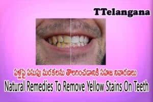 పళ్లపై పసుపు మరకలను తొలగించడానికి సహజ నివారణలు,Natural Remedies To Remove Yellow Stains On Teeth
